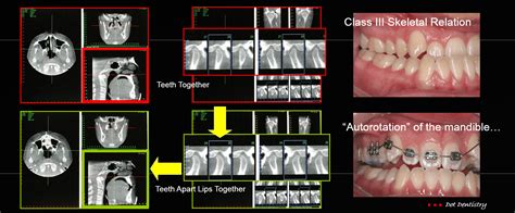 Orthodontics Psuedo Class Iii Maxillary Arch Correction With Gnm