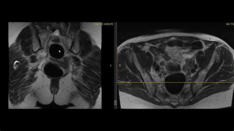 Pelvic Lesion Symptoms - Infoupdate.org