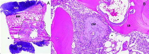 Histological Features Of Phosphaturic Mesenchymal Tumors Pmts Panel