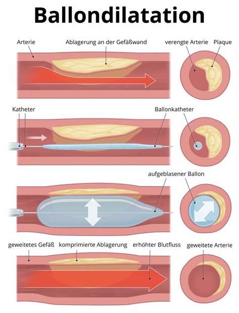 Ballondilatation Einsatzgebiete Durchführung Risiken