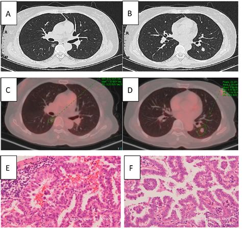 Figure 1 From Synchronous Multiple Primary Lung Cancers With Shared Egfr Mutation But