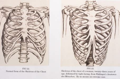 The Dangers Of Tight Lacing The Effects Of The Corset Royal College