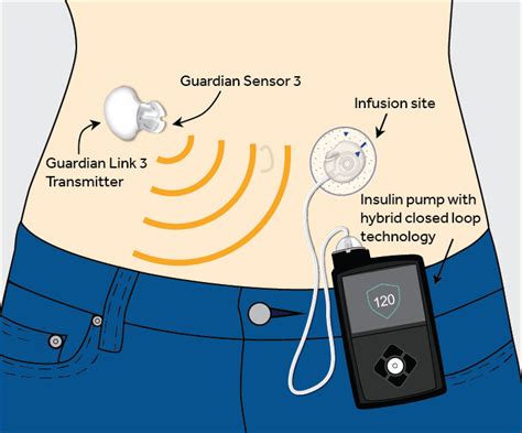 USA Weltweit Erstes Hybrid Closed Loop System Ist Auf Dem Markt