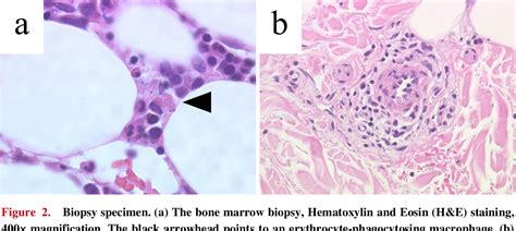 Figure From Hemophagocytic Lymphohistiocytosis In A Patient With