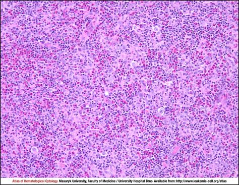 Mixed Cellularity Classic Hodgkin Lymphoma Cell Atlas Of