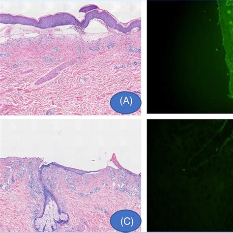 A Pathological Biopsy Revealed Subepidermal Blister He ×20 B Download Scientific Diagram