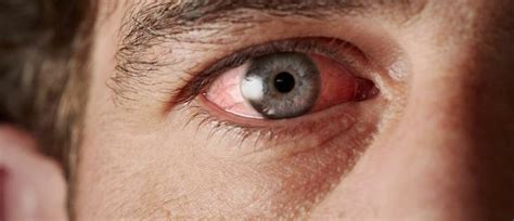 Understanding the causes of chronic dry eye » TheHop.com