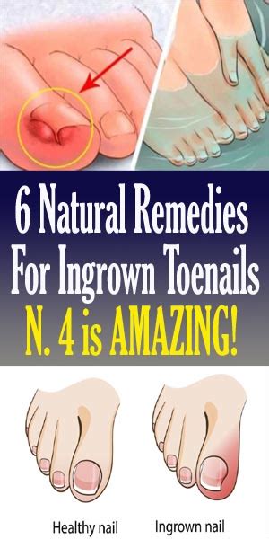 6 Natural Remedies For Ingrown Toenails World Of Health