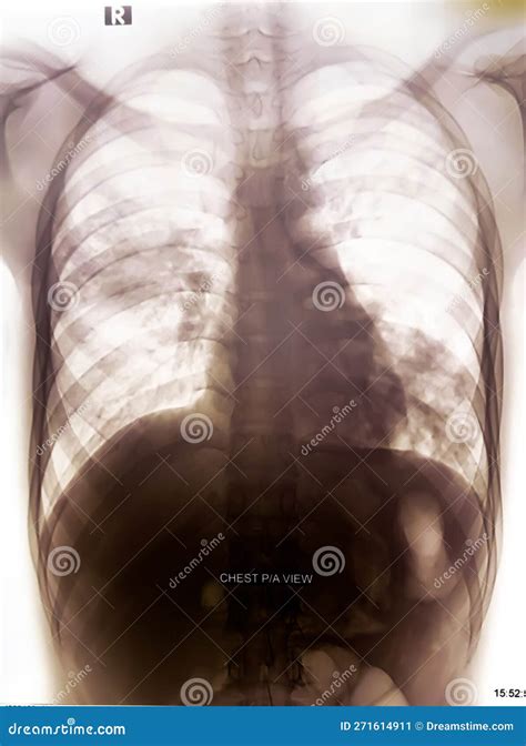 Chest X Ray Pa View Show Suggestive Of Bilateral Pneumonitis Stock