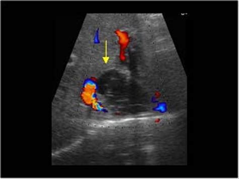 Abdomen And Retroperitoneum Liver Case Hydatid Cysts