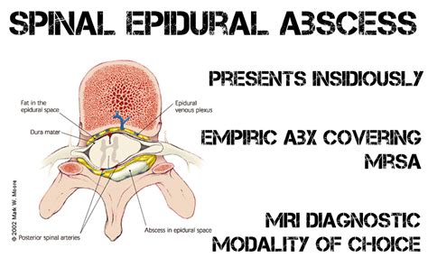 Spinal Epidural Abscess (SEA) - REBEL EM - Emergency Medicine Blog