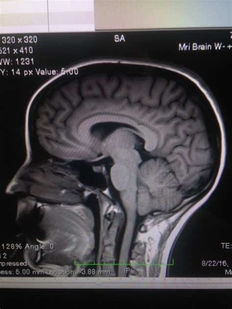 Cerebellar Tonsils Mri