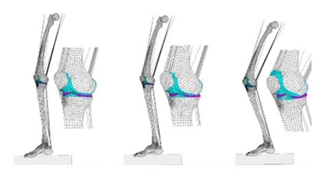 Finite Element Model Of The Knee Joint Included In The Simulation Of