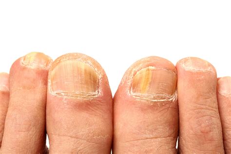 Top 10 Natural Home Remedies For Removing Yellow Nails