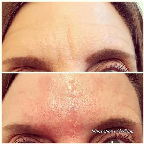 botox to prevent forehead wrinkles picture » Facial Injections: Info ...