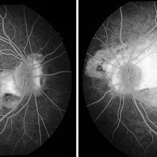 Fluorescein Angiography Late Phase Taken When The Patient Came With