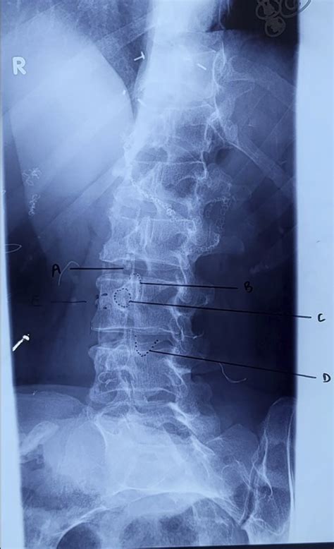 L Spine Oblique Diagram Quizlet