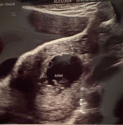 10 Week Ultrasound - August 2024 Babies | Forums | What to Expect