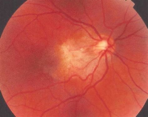 Figure From Clinical Ophthalmology Dovepress Dovepress Spontaneous