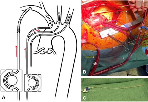 Uni Versus Bilateral Antegrade Cerebral Perfusion During Repair Of