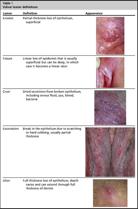 Table 1 From Fissures Herpes Simplex Virus And Drug Reactions