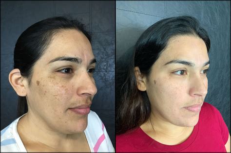 Cosmelan Peel Evansville Pigmentation Reduction Treatment