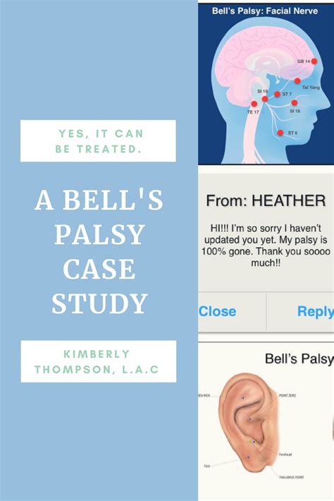 Bells Palsy Part 2 Acupuncture Technology News Bells Palsy Bells Palsy Cure Acupuncture