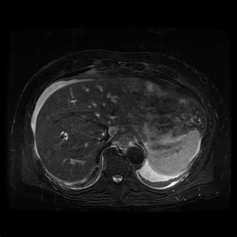 File:Journey through necrotizing pancreatitis - presentation, walled ...