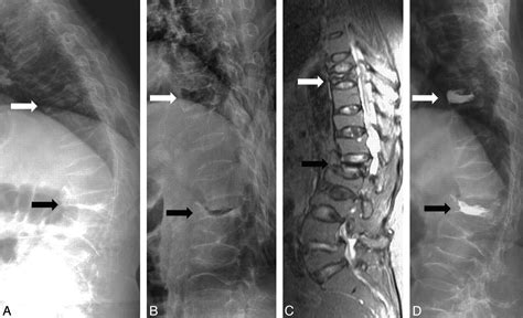 Compression Fracture X Ray