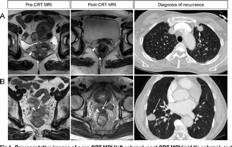 Figure 1 From MRI Risk Stratification For Tumor Relapse In Rectal