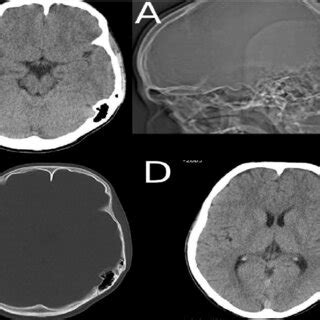 Computed Tomography Ct Of The Brain A Skull X Ray B C Computed