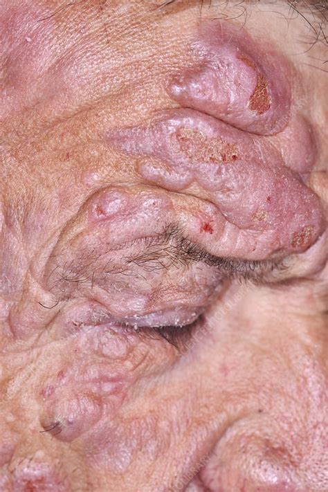 Mycosis Fungoides Pictures Stage