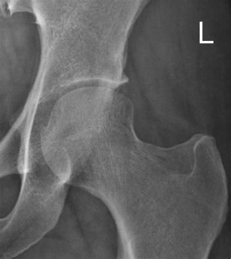 Pdf Calcific Tendonitis Of The Rectus Femoris Hot Sex Picture