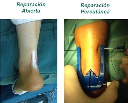 Rotura Tendon De Aquiles Juan Arnal Traumatologo En Madrid