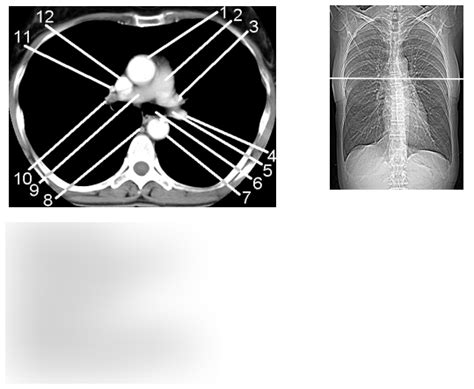 Diagram Of Axial Enhanced Chest W Mediastinal Windows 10 Quizlet