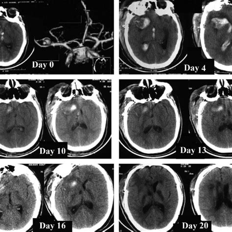 CT scan on Day 0 shows subarachnoid hemorrhage with intraventricular... | Download Scientific ...