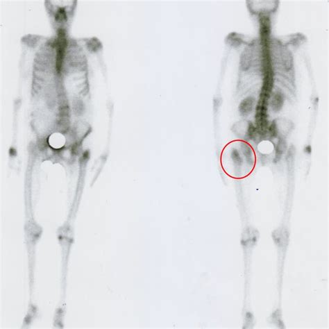 Anterior A And Posterior B Planes Of Wholebody Bone Scan Showing