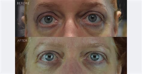 Eyelid Retraction Repair Before And After Photos Kirkland Bellevue