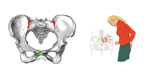 Pelvic Girdle Pains In Pregnancy How To Deal With It Will I Be Able