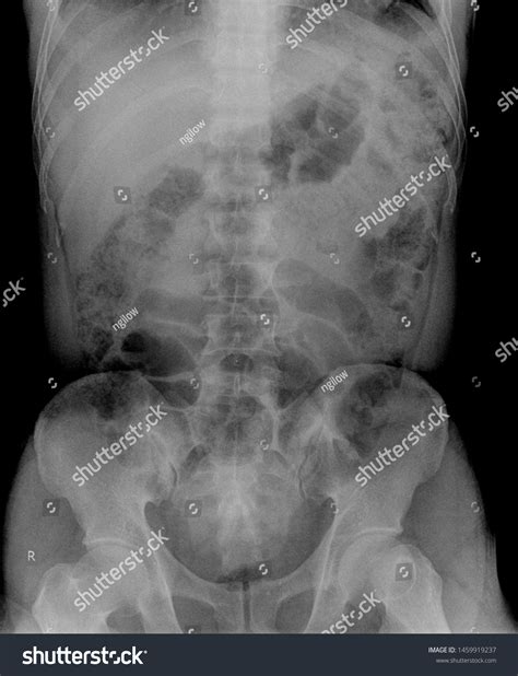 Genu X Ray Anatomy Radiology Radiographic Stock Photo 1459919237