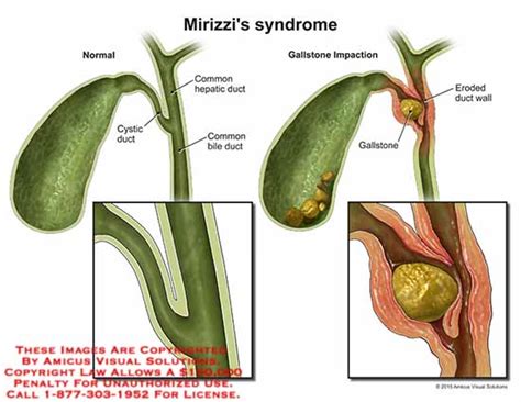 Amicus Illustration Of Amicusinjurymirizzisyndromenormalcystic