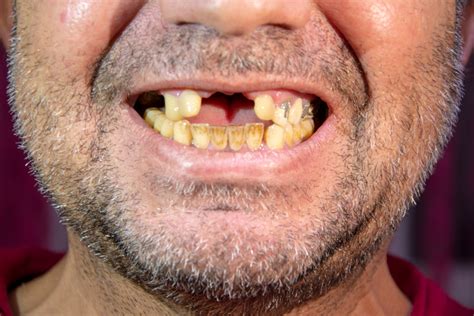 Gum Disease Treatment Can Help Recovering Addicts Functional