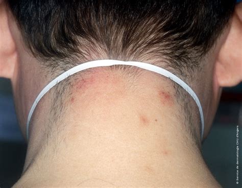 Eczema On Neck