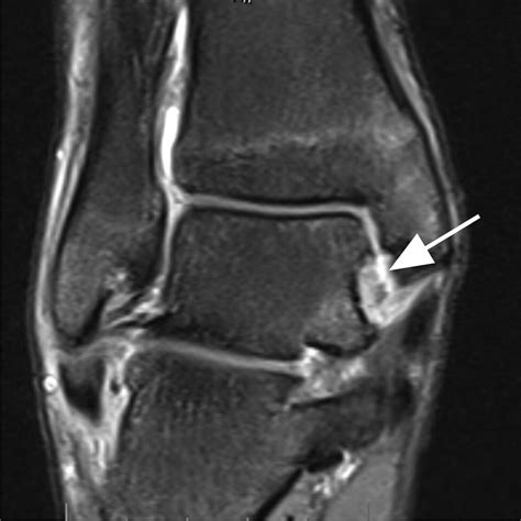 MRI Of Ankle Sprain: The Association Between Joint Effusion, 41% OFF