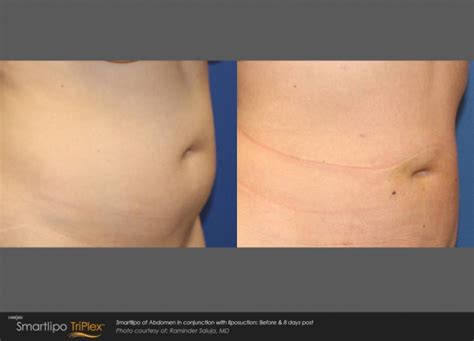 Newport Beach Medspa Liposuction With Smartlipo