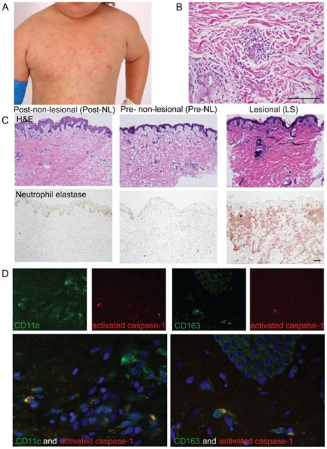 A Appearance Of The Classical Urticaria Like Rash Of Nomid With