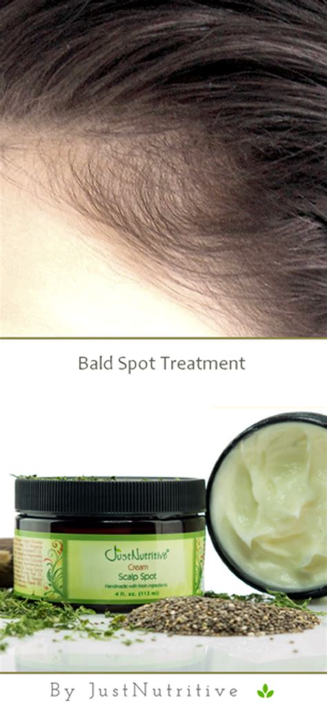 Bald Spot Treatment