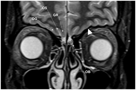 Imaging Review Of The Anterior Skull Base Olivia Francies Levan