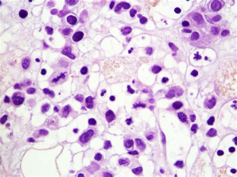 Pathology Outlines Aggressive Nk Cell Leukemia