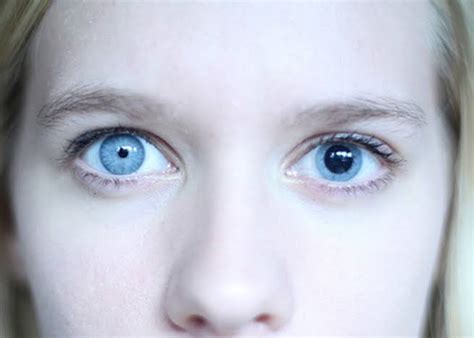 Anisocoria - Types, Symptoms, Causes & Treatment - Santripty